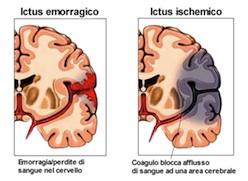 “Rotary No Ictus Screening Program per la prevenzione dello stroke”